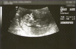 ultrasound for nt scan
