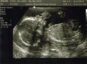 Ultrasound 19w6d