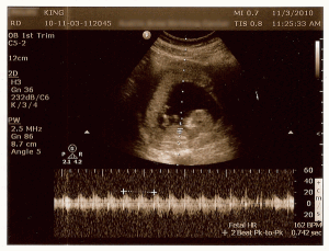 Stree at 11 weeks
